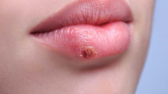 Herpes na usni – kako se riješiti herpesa preko noći